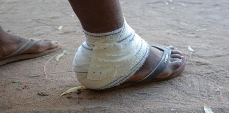 infected feet